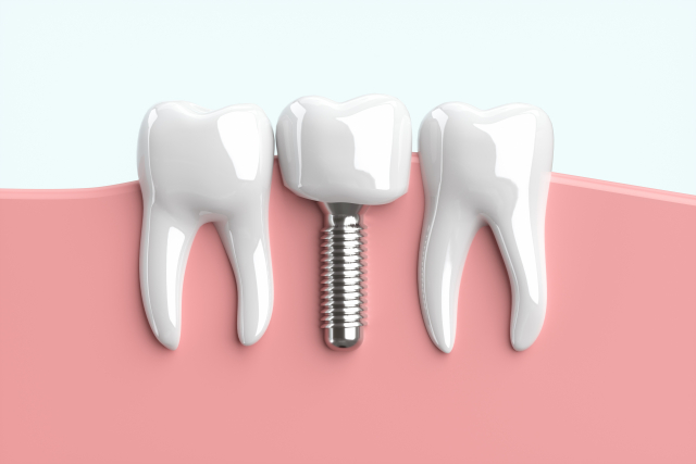 インプラント治療の費用について知っておくべきこと